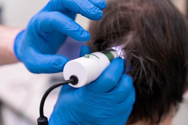 Low-Level-Lasertherapie in der Trichologie
