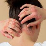 seborrhoische Dermatitis