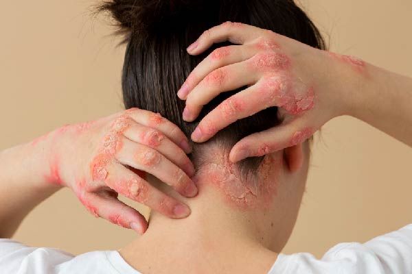 seborrhoische Dermatitis