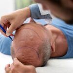 Was haartransplantation Türkei kosten