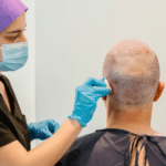 Die beste haartransplantation Deutschland