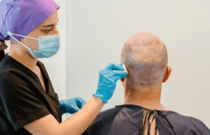 Die beste haartransplantation Deutschland