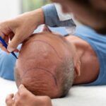 Ist die Haartransplantation dauerhaft?