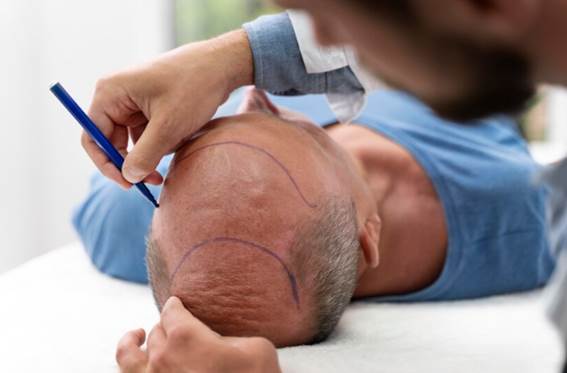 Ist die Haartransplantation dauerhaft?